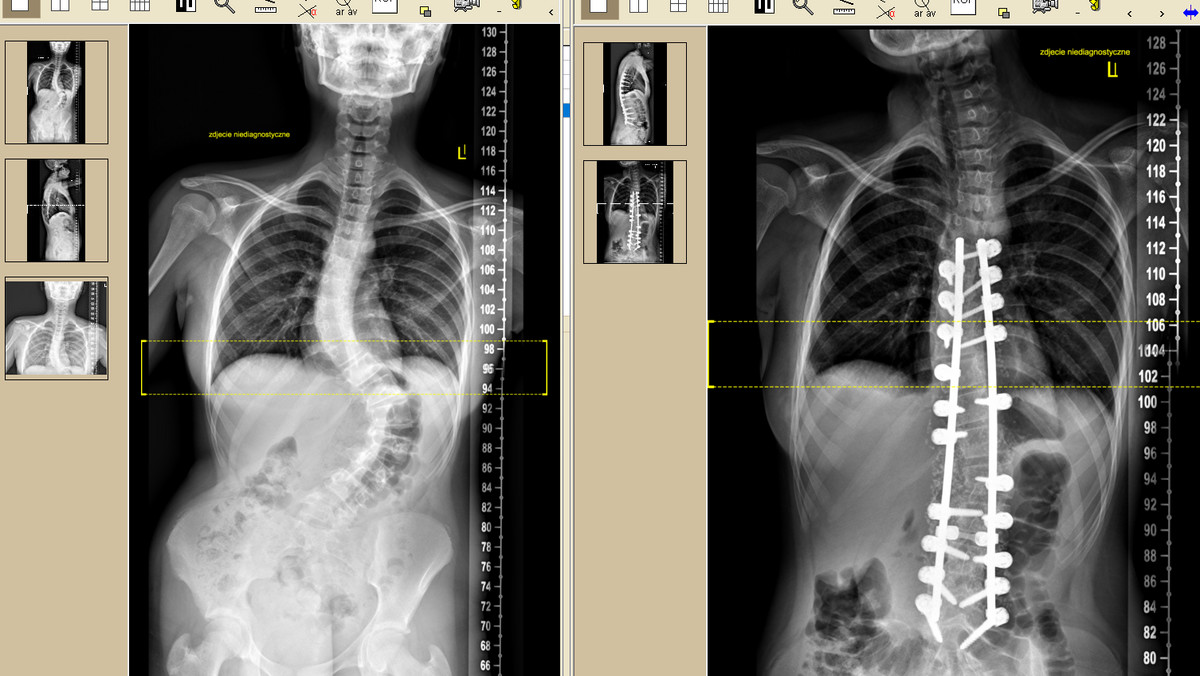 Kręgosłup 13-letniej Natalii przed i po operacji