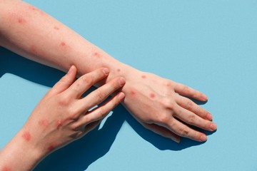 Alaszkai himlő: a tünetek elsőre könnyen összetéveszthetők egy pókcsípéssel