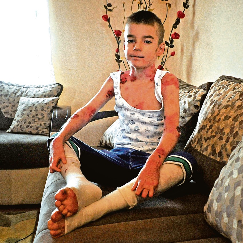 Flaster košta 100 evra, a dečaku je potrebno bar 30 mesečno. Despotovi roditelji nemaju para, pa kuvaju gazu, vazelin i emolijans kremu i lepe mu na rane