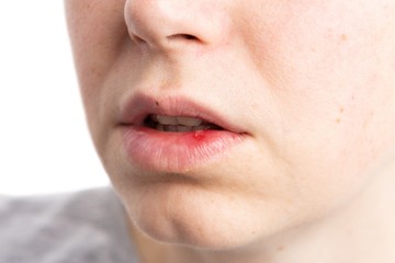 Apró kiütések, hólyagok, dudorok a szájon: ezek a betegségek okozhatják