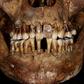 Zęby Anne d’Alègre, XVII-wiecznej arystokratki, Institut National de Recherches Archéologiques Préventives (INRAP)