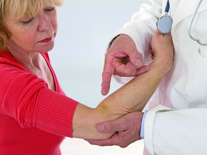 Modrice se često javljaju zbog urođene slabosti zida krvnog suda, ali i zbog nedostatka vitamina C