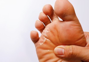 Ljuštenje i perutanje kože na stopalima može biti posledica suve kože, gljivičnih infekcija, dermatoloških oboljenja ili iritacije i opekotina