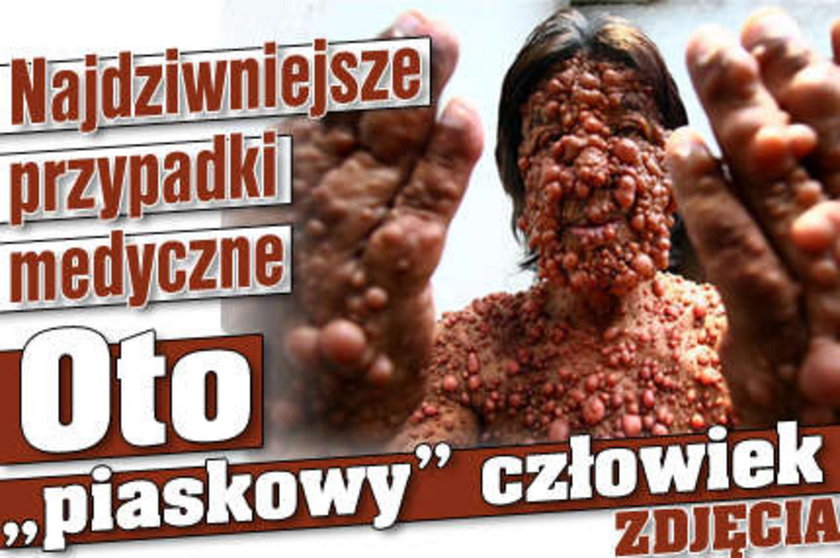 Okropna choroba. Mężczyzna ma bąble na całym ciele!