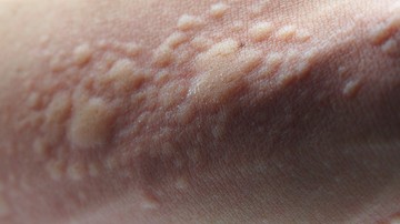 viszketés, csalánkiütés, allergia, ekcéma, krónikus csalánkiütés