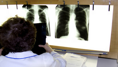 11 znaków, że twoje płuca są w fatalnym stanie. Nie wolno lekceważyć