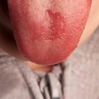 Nyelven lévő dudorok, sebek – van, hogy súlyos állapotot jeleznek
