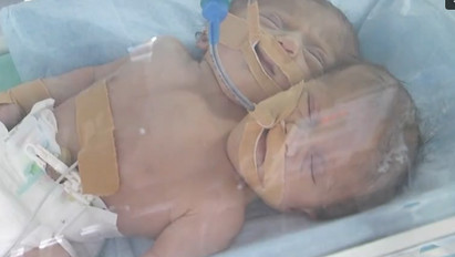 Gázai horror sztori: két fejjel, de egy testtel születtek a csecsemők - Videó