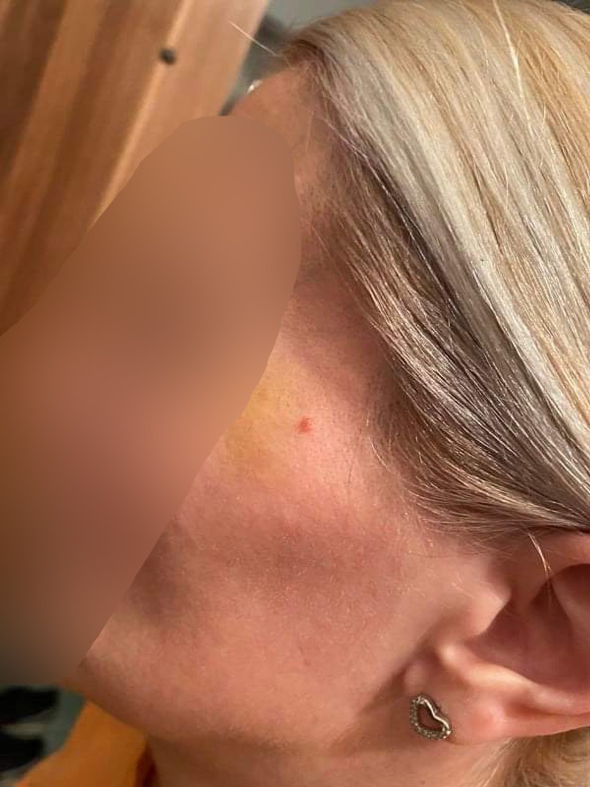 Masnica na licu napadnute žene