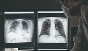 Jak wyglądają płuca po COVID-19?