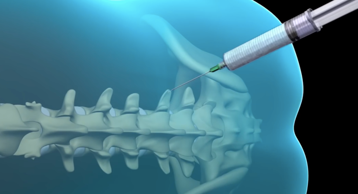 Блокада грыжи позвоночника что это. Сакральная эпидуральная блокада. Блокада пояснично-крестцового отдела схема. Блокада грыжи поясничного отдела позвоночника. Блокада позвоночника при грыже.