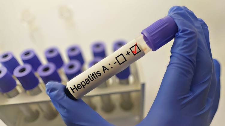 hepatitis A vírus NNGYK terjed hírek