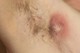 A HS rendszerint pattanásszerű dudorként kezdődik ott, ahol általában pattanás (acne) nem jellemző, ezért acne inversának is nevezik.