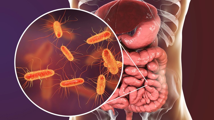 stroke, mikrobiom, baktériumok daganat, tumor laboratóriumi vizsgálatok