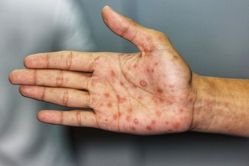 A második fázis vagy másodlagos vérbaj a primer fekélyt követő 1-6 hét múltán jelentkezik. Apró lapos (macula) vagy a bőrfelszínből enyhén kiemelkedő kiütések (papula) formájában, melyek testszerte, a tenyéren és talpon is észlelhetők. 