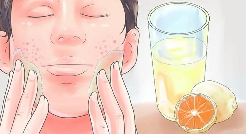 How to get rid of pimples