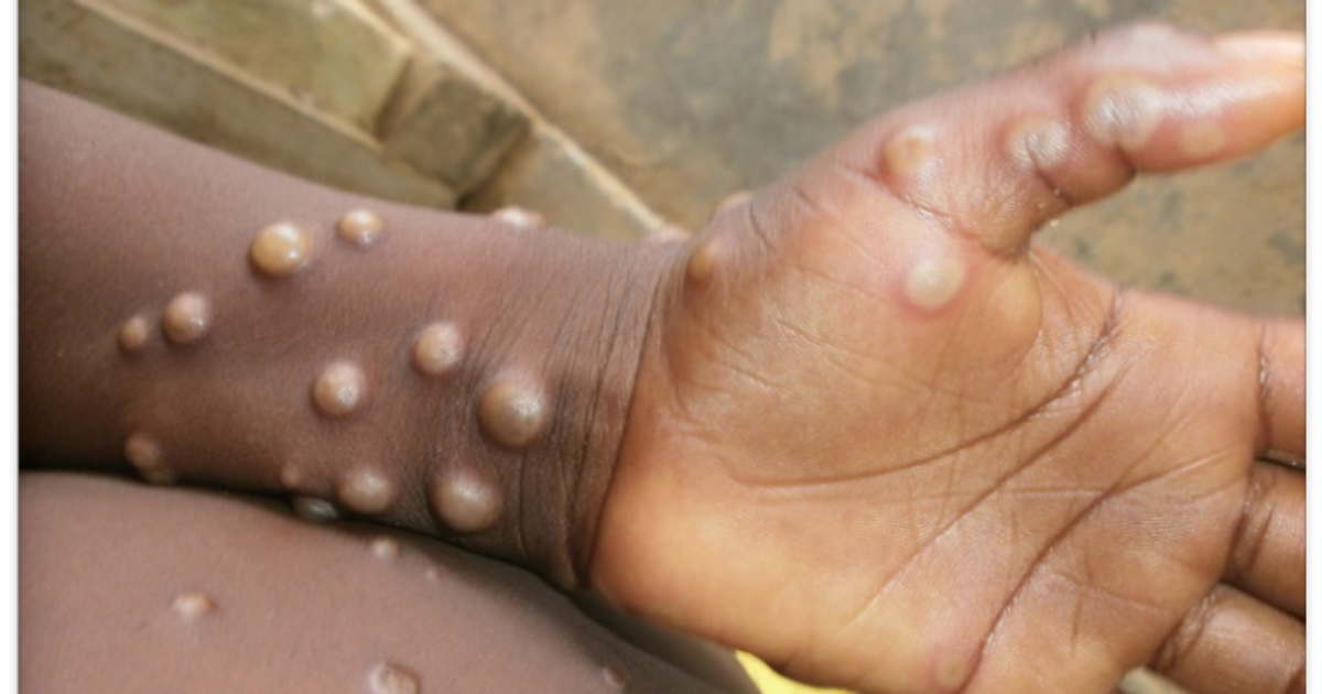 Africa CDC – 12 African countries report 1,782 cases of monkeypox - Vimarsana News