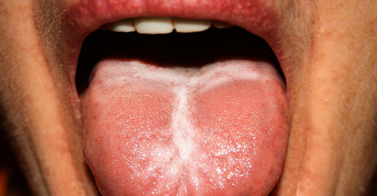 Biały nalot na języku – skąd się bierze i jak go leczyć?