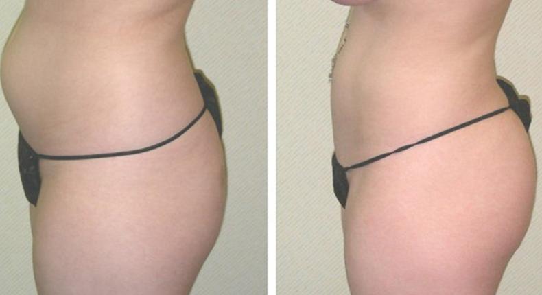 Transfer of belly fat to butt