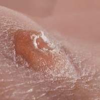 A bél baktériumflórája is segíthet a HPV legyőzésében - ezeket tartsa be!