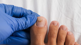 Grzybica paznokcia u nóg