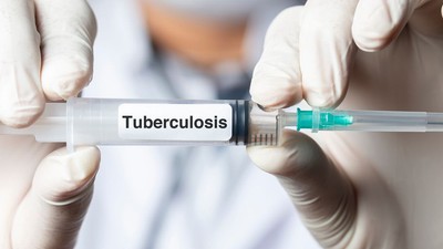 Wellcome, Gates Foundation funds new tuberculosis (TB) vaccine in 100 years advance (Credit: Today's Clinical Lab)