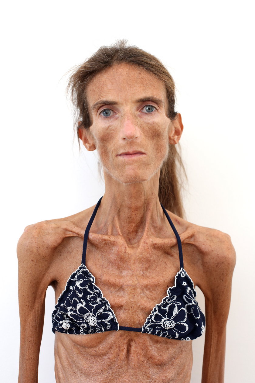 Waży tylko 25 kg! Oto najchudsza kobieta świata! Valeria Levitin - straszna  anoreksja