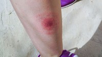 Így kezelhető a Lyme-kór különböző stádiumokban című cikk nyitóképe