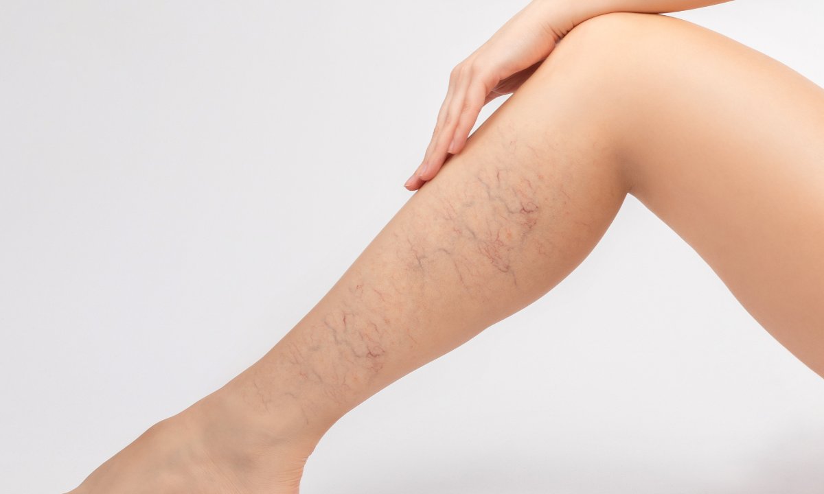 Balsam z kasztanowcem na ciężkie nogi z obrzękami i żylakami! Działa cuda na pajączki