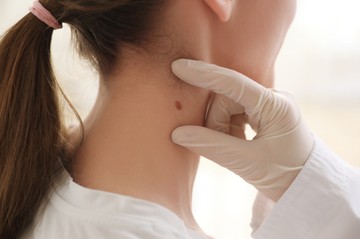 Melanóma: gyorsan kialakulhat az áttét! Ennél a pontnál ne halogassa az orvost