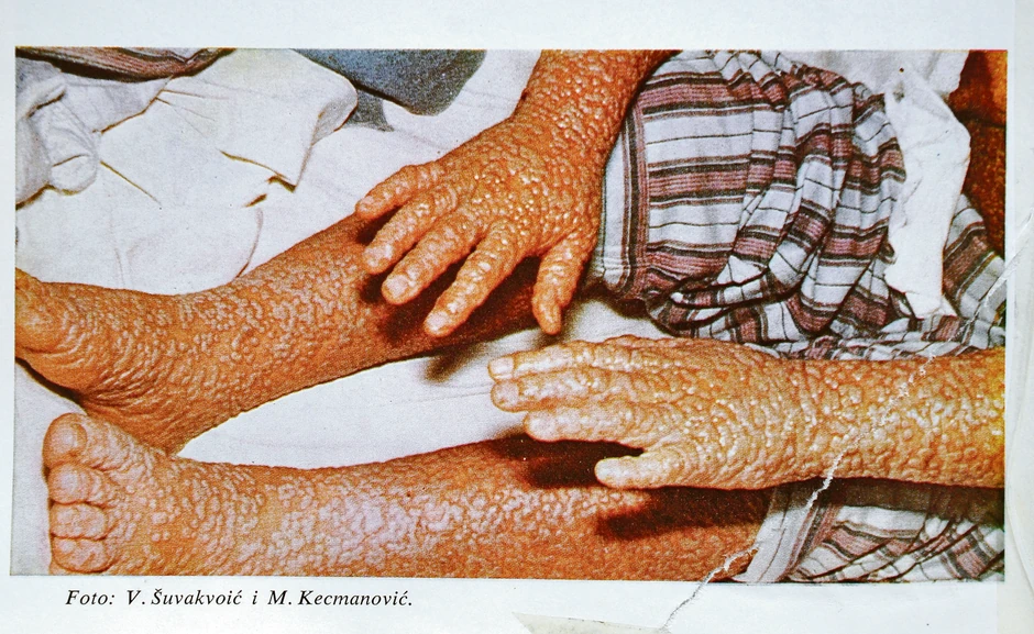 U Srbiji je obolelo 175 osoba, na Kosovu je preminulo 25 a u Beogradu šestoro ljudi