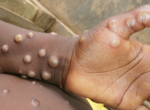 Africa CDC to declare health emergency as Mpox cases surge 160% in 2024