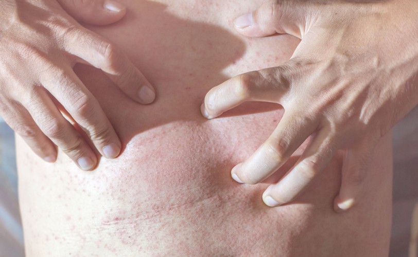 3. Wysypka na skórze