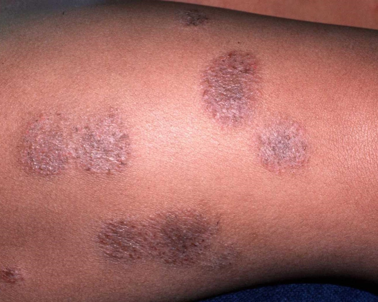 What causes eczema and how to treat it Pulse Nigeria