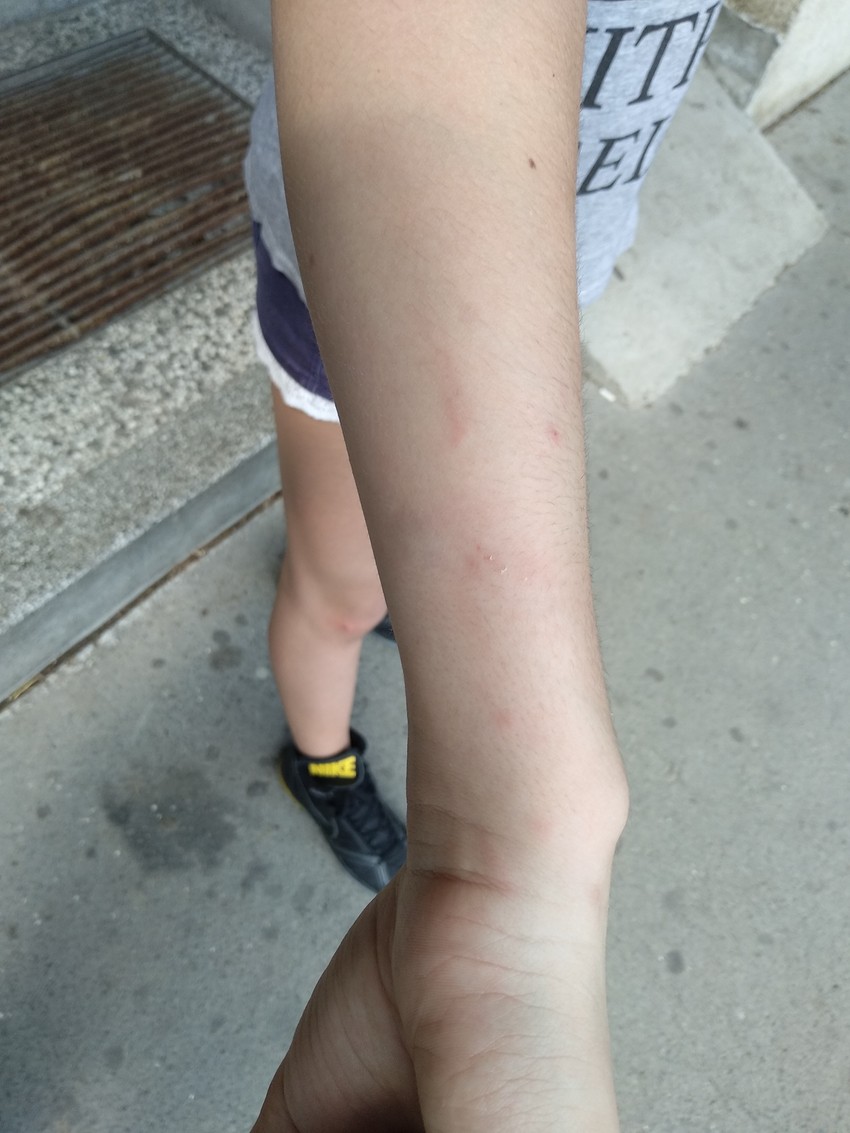 Pas je devojčicu ujeo za ruku i nogu