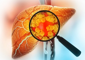 Metabolička bolest jetre je često povezana sa viškom kilograma 