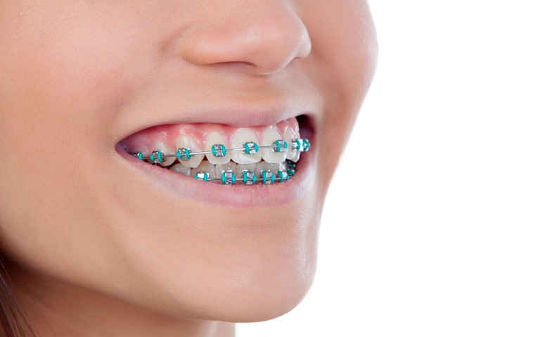 Aparaty ortodontyczne czechy