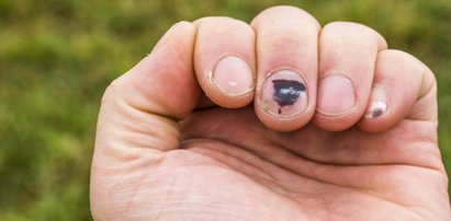 Masz taką plamkę na paznokciu? Uważaj, to może być nowotwór