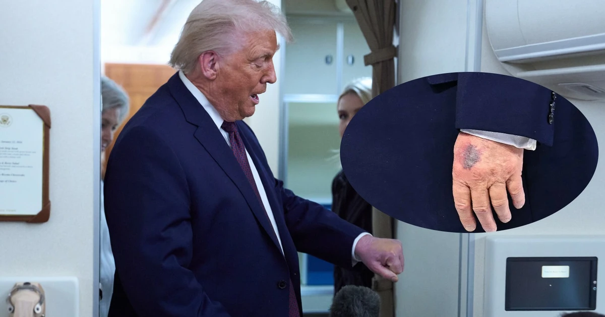 Stan zdrowia Donalda Trumpa budzi niepokój. Powraca potężny siniak na dłoni