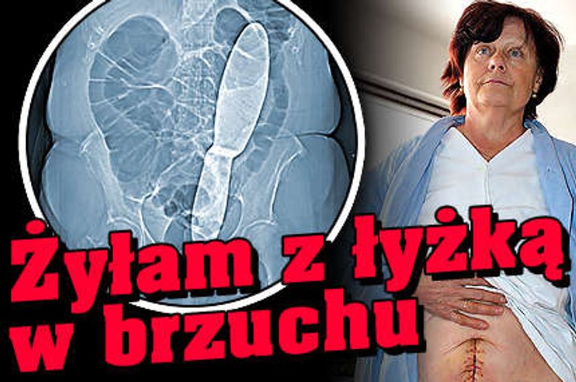 Żyłam z łyżką w brzuchu