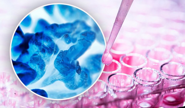 Anemija može da bude simptom raka, ali i neželjeni efekat lečenja malignih bolesti