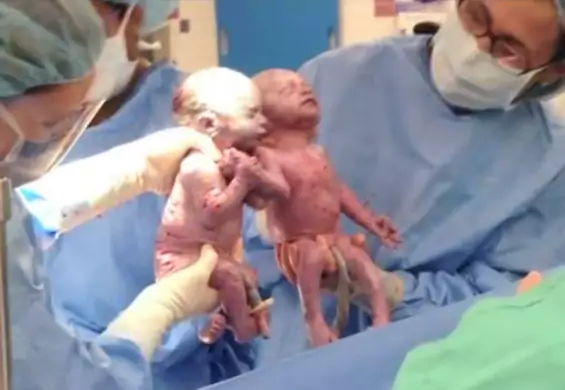 Urodziły się, trzymając się za ręce. Nadal zadziwiają lekarzy, którzy nie dawali im żadnych szans