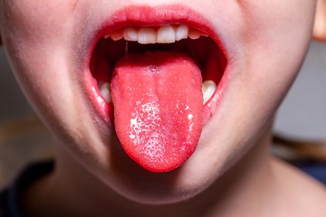 A skarlátot tipikus gyermekbetegségnek tartják, a legtöbb érintett 5 és 15 év közötti. Természetesen, ennél idősebbek és fiatalabb is elkaphatják, bár jóval ritkábban, és esetükben a tünetek sem tipikusak. 