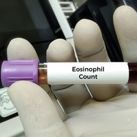 Mitől lehet magas a eosinophil a vérképben? Ezeket mindenképp tudnia kell!
