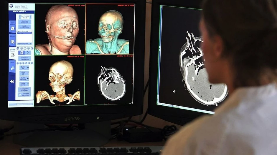 Virtuelne autopsije rade se uz pomoć slika dobijenih preko CT skenova, magnetne rezonance i sonografije da bi se proučila tela | Foto: AFP