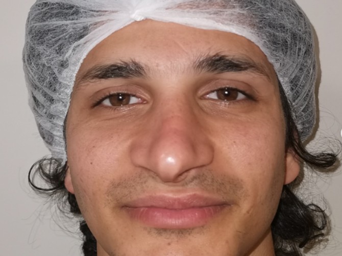 Turski hirurzi izveli transformaciju godine, žene se instant zaljubile u novo lice muškarca sa slike
