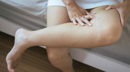 Obrzęk nóg to jeden z możliwych objawów zakrzepicy po szczepionce