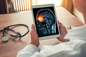 A neurosifilisz minden formája meningitissel kezdődik. Ez a szifilisz esetek körülbelül 25% -ában fordul elő.