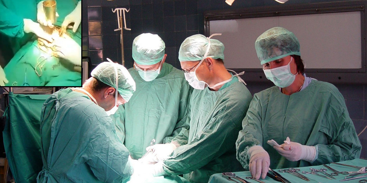 Indie. Lekarze usunęli metalowy kubek z żołądka mężczyzny.