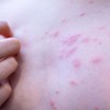 Stopala su posebno izložena ujedima ovih buba jerdolaze u direktan kontakt sa peskom, kamenjem, školjkama, insektima i morskom vodom